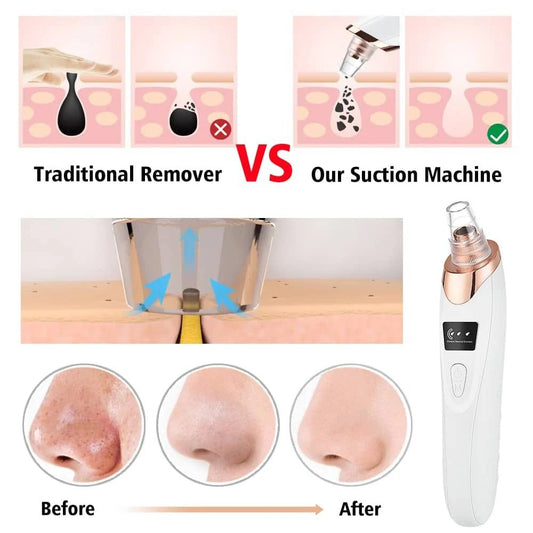 Electric Blackhead Remover | Vacuum Acne & Pore Cleaner